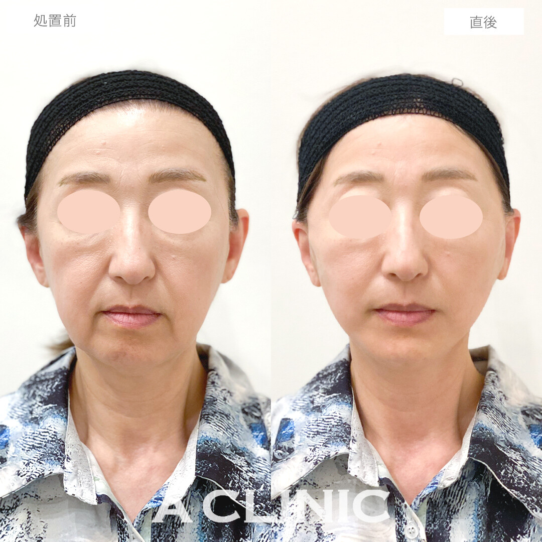 Aスレッドで劇的な若返り効果とたるみのリフトアップ！処置前と直後の症例です(50代女性)