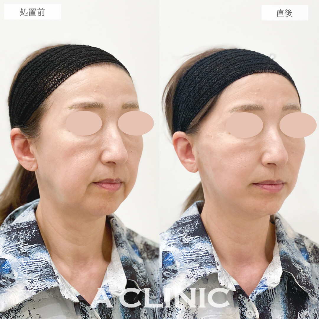 Aスレッドで劇的な若返り効果とたるみのリフトアップ！処置前と直後の症例です(50代女性)