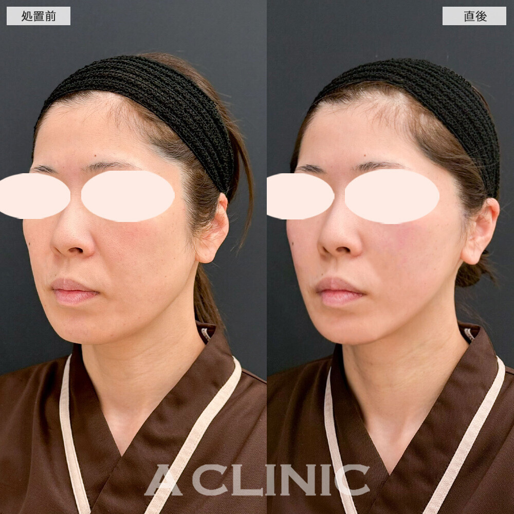 Aスレッドでお顔のもたつきがなくなりシュッとした輪郭に！こちら処置前と直後の症例です。(40代女性)