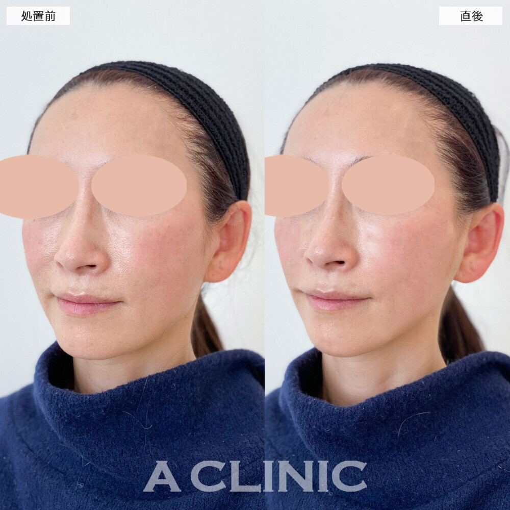 Aスレッドでナチュラルなリフトアップ！こちら処置前と直後の症例です。(50代女性)