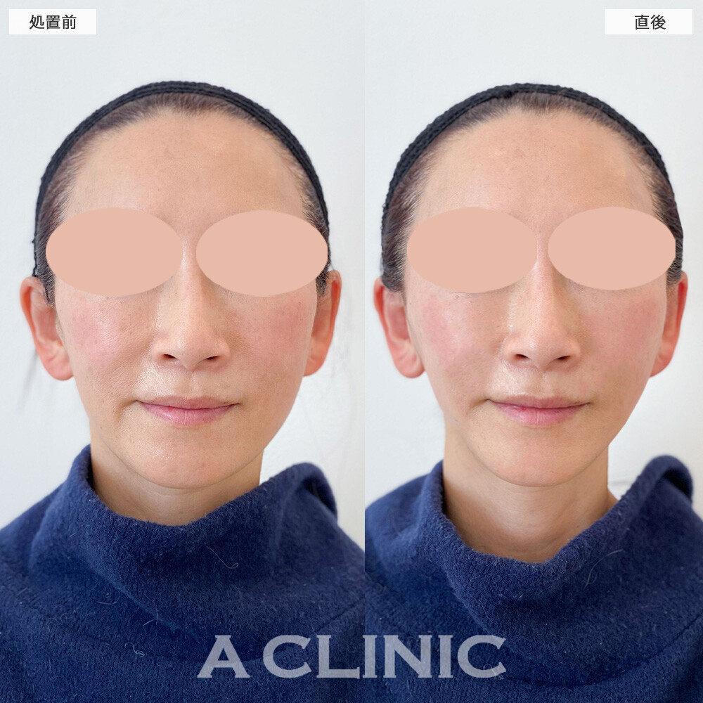 Aスレッドでナチュラルなリフトアップ！こちら処置前と直後の症例です。(50代女性)