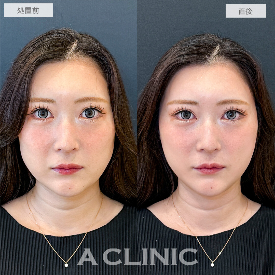 Aスレッドで頬コケと口横のもたつきが改善して輪郭が整いました！こちら処置前と直後の症例です(30代女性)