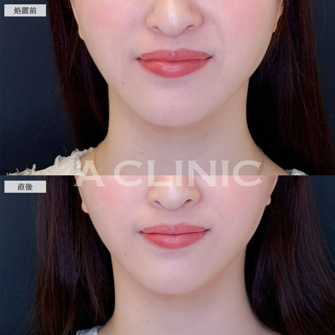 Aスレッドできれいなフェイスラインが爆誕！こちら処置前と直後の症例です(20代女性)