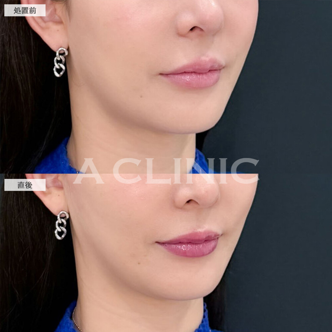 Aスレッドで左右差整えながらほうれい線も目立たなくなりました！こちら処置前と直後の症例です(40代女性)