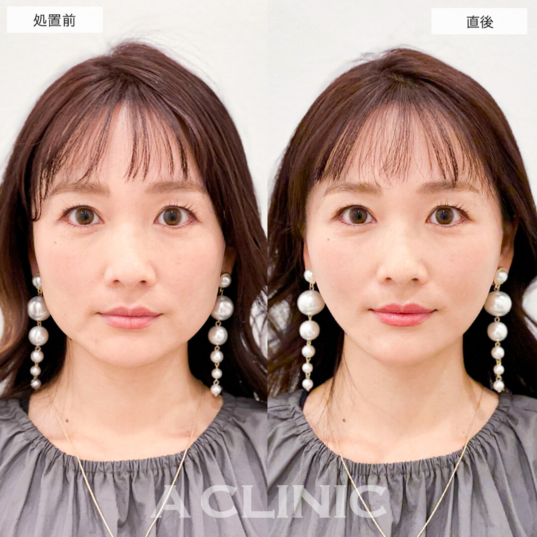Aスレッドで輪郭の左右差が改善し自信が持てるようになりました!こちら処置前と直後の症例です(30代女性)
