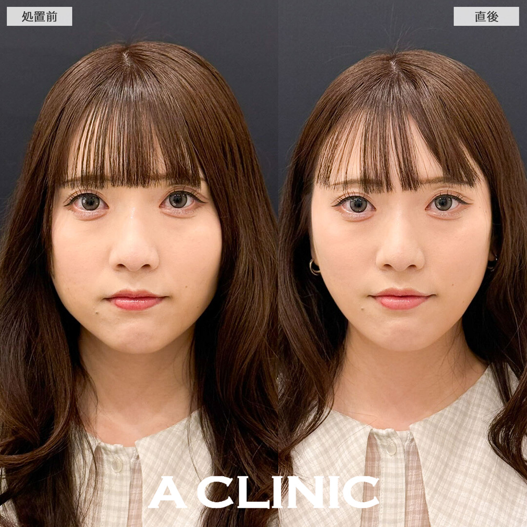 Aスレッドで痩せても減らなかったお顔の脂肪を引き上げました！こちら処置前と直後の症例です(20代女性)