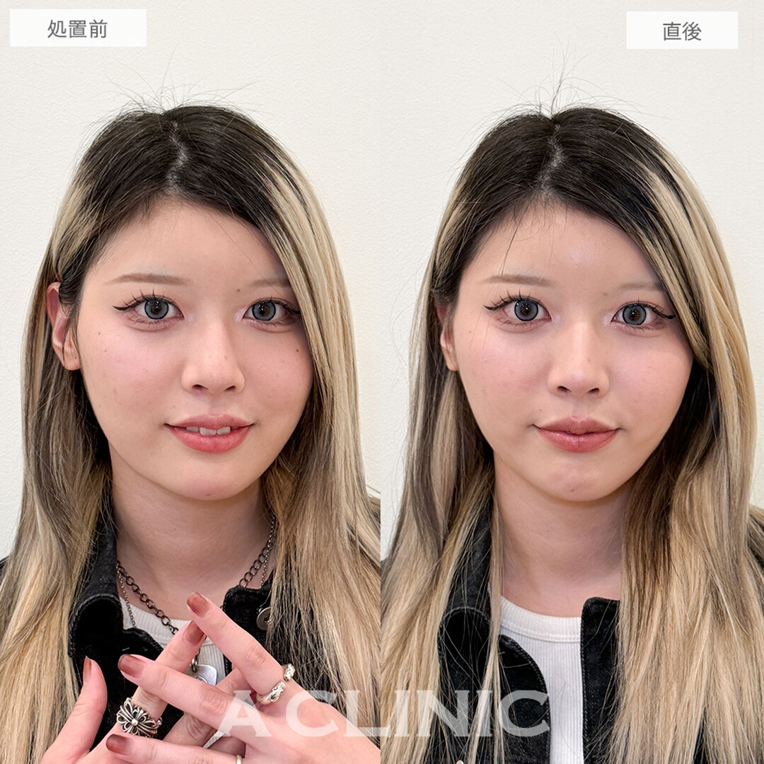 Aスレッドで理想のリフトアップ！こちら処置前と直後の症例です(20代女性)