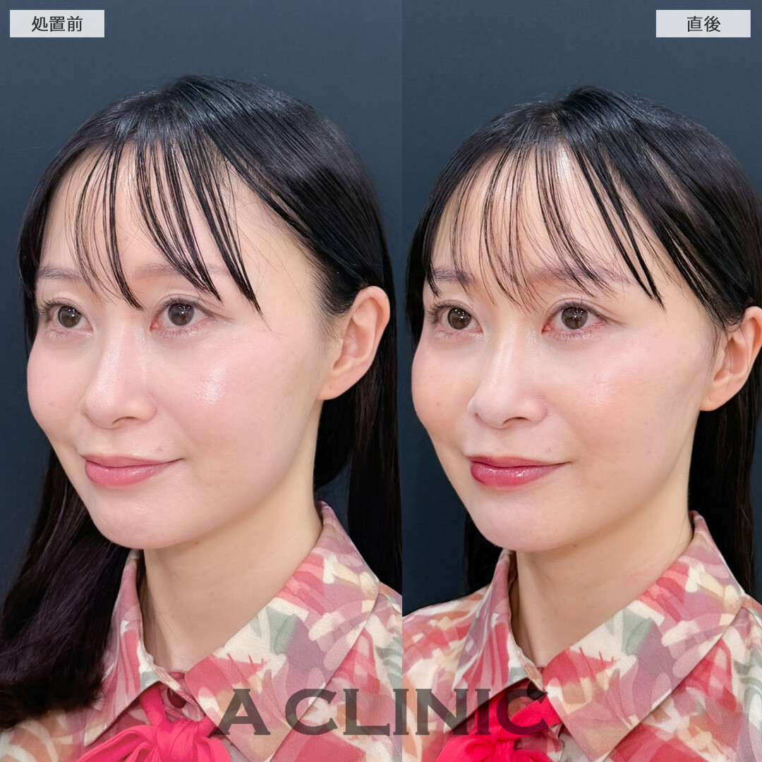 Aスレッドでたるみ引き上げてさりげなく若返り！こちら処置前と直後の症例です(30代女性)