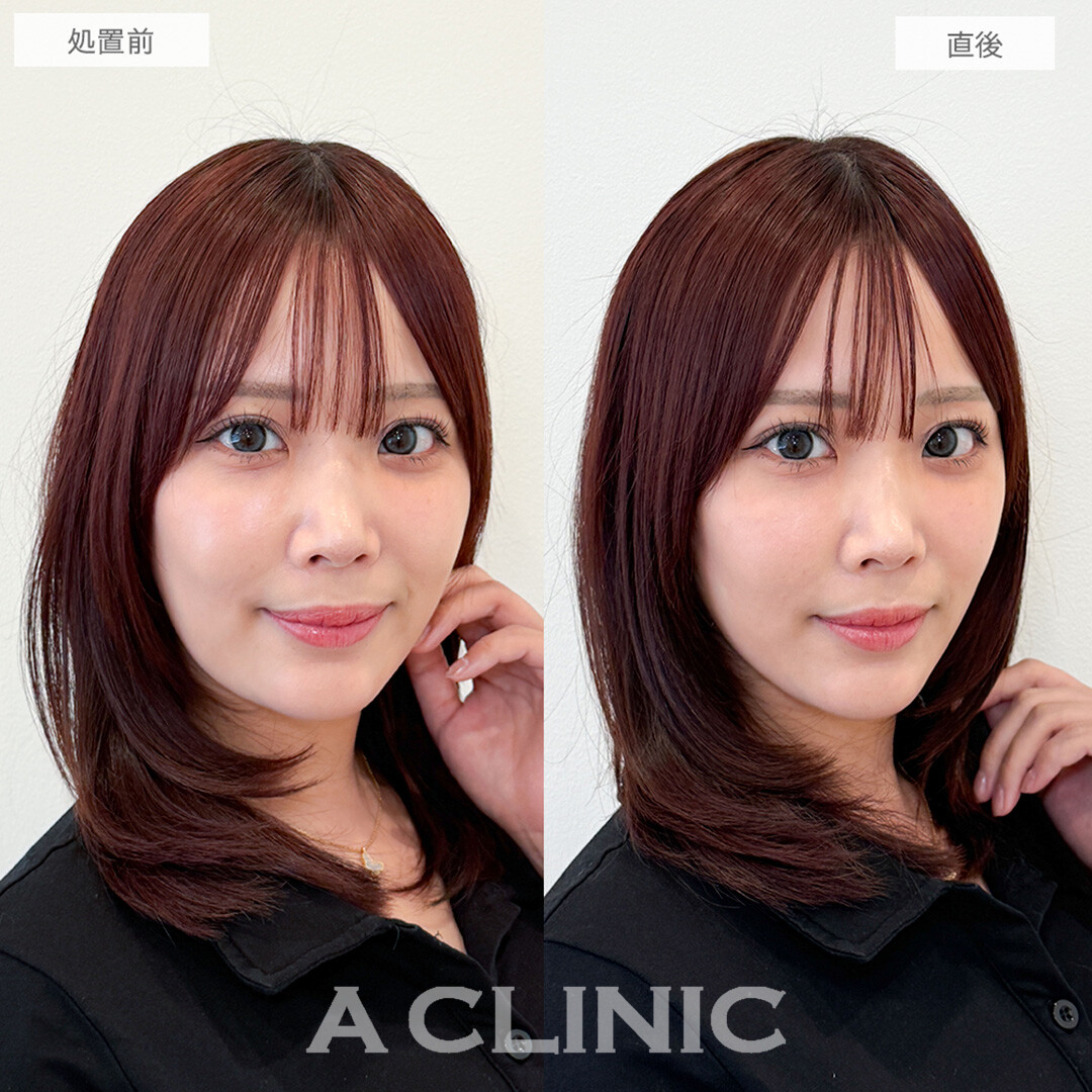 Aスレッドで口横のポニョ解消！こちら処置前と直後の症例です(30代女性)