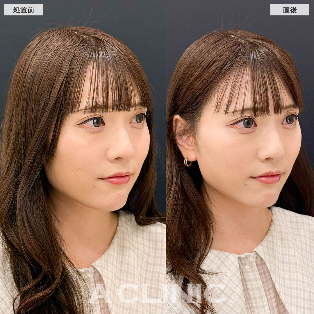 Aスレッドで痩せても減らなかったお顔の脂肪を引き上げました！こちら処置前と直後の症例です(20代女性)