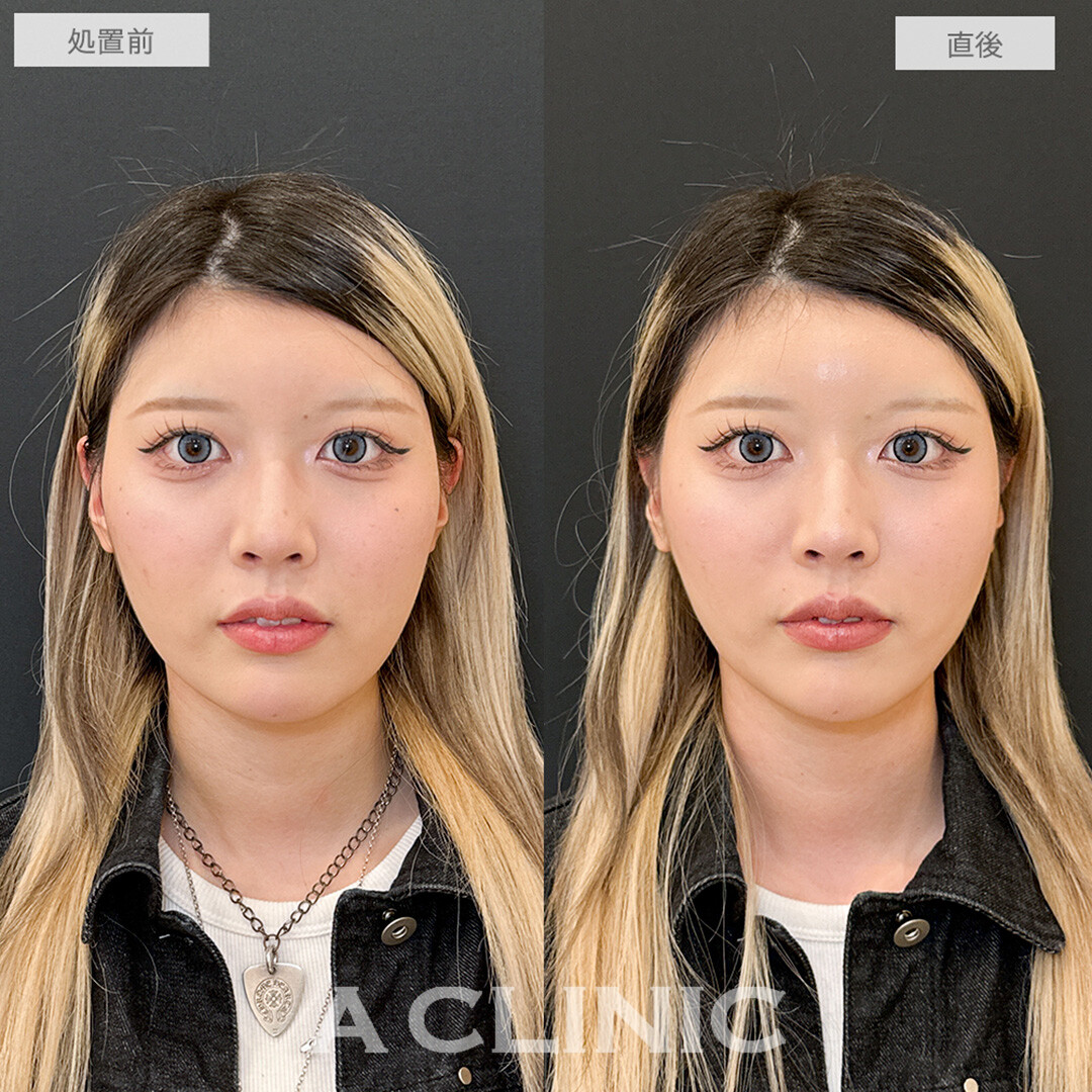 Aスレッドで理想のリフトアップ！こちら処置前と直後の症例です(20代女性)
