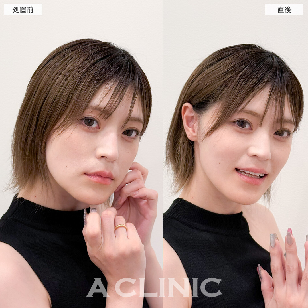 Aスレッドで口横のぽにょを引き上げ一気に即日若返り！処置前と直後の症例です(30代女性)