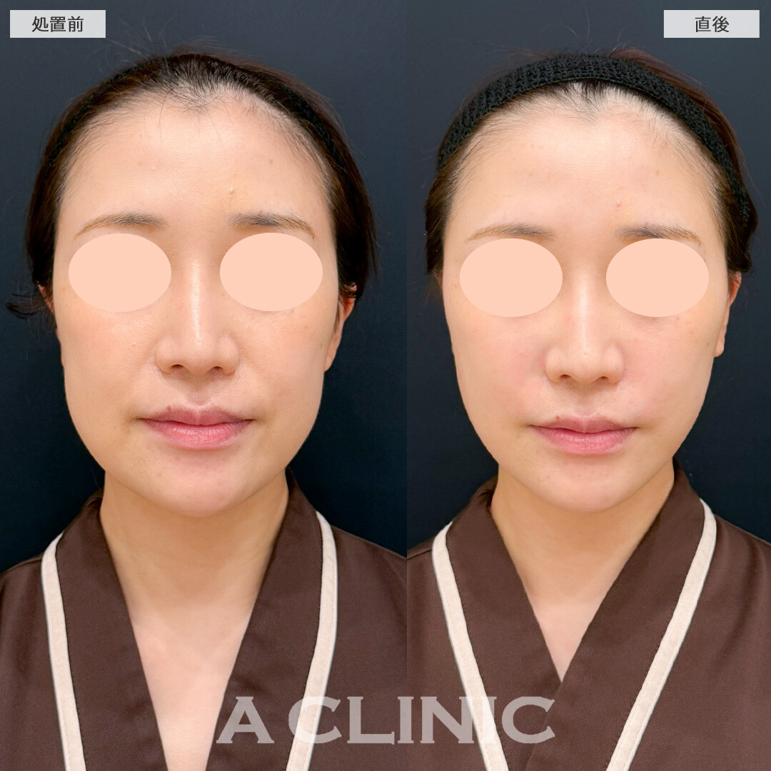 Aスレッドで下顔面のたるみと左右差を軽減！処置前と直後の症例です(20代女性)