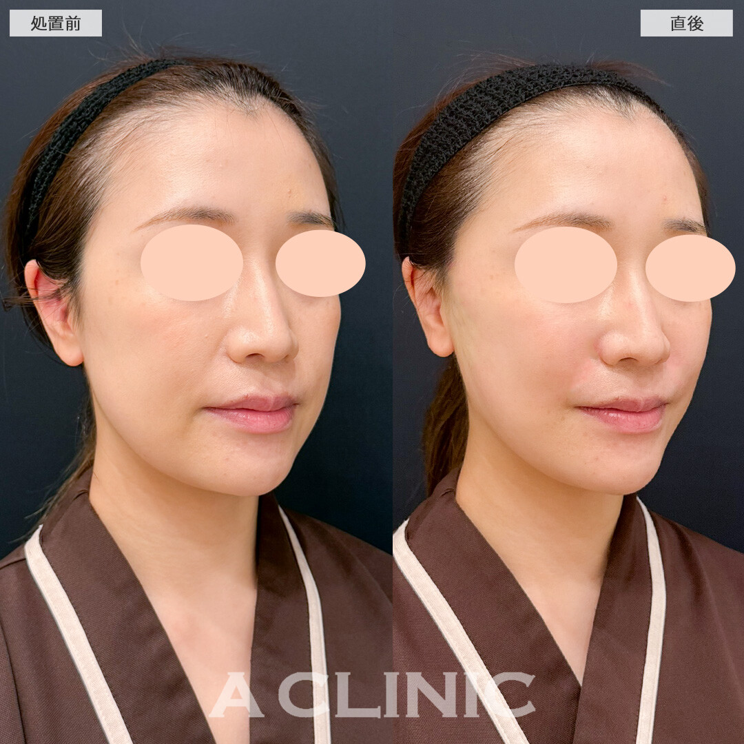 Aスレッドで下顔面のたるみと左右差を軽減！処置前と直後の症例です(20代女性)