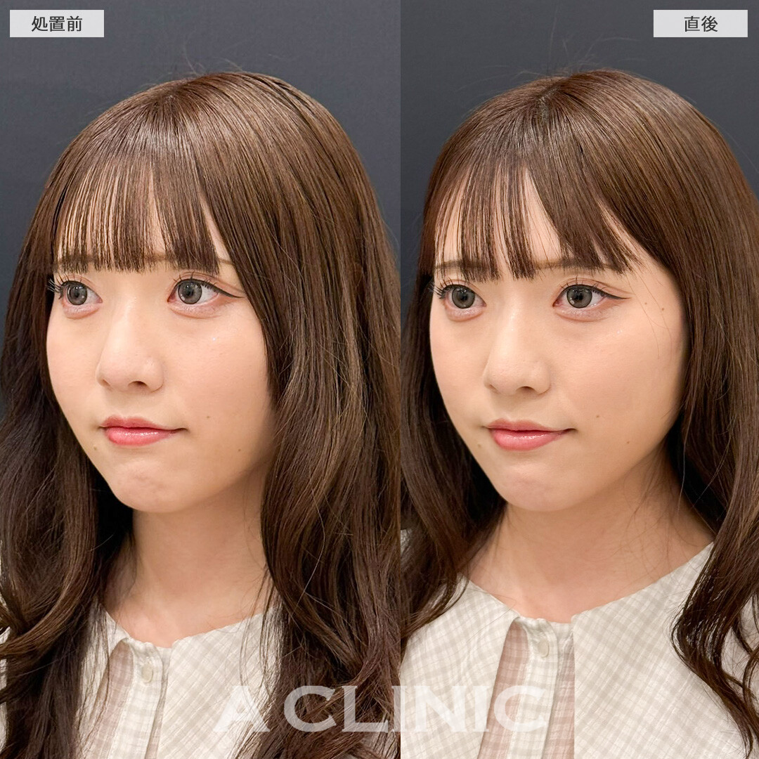 Aスレッドで痩せても減らなかったお顔の脂肪を引き上げました！こちら処置前と直後の症例です(20代女性)