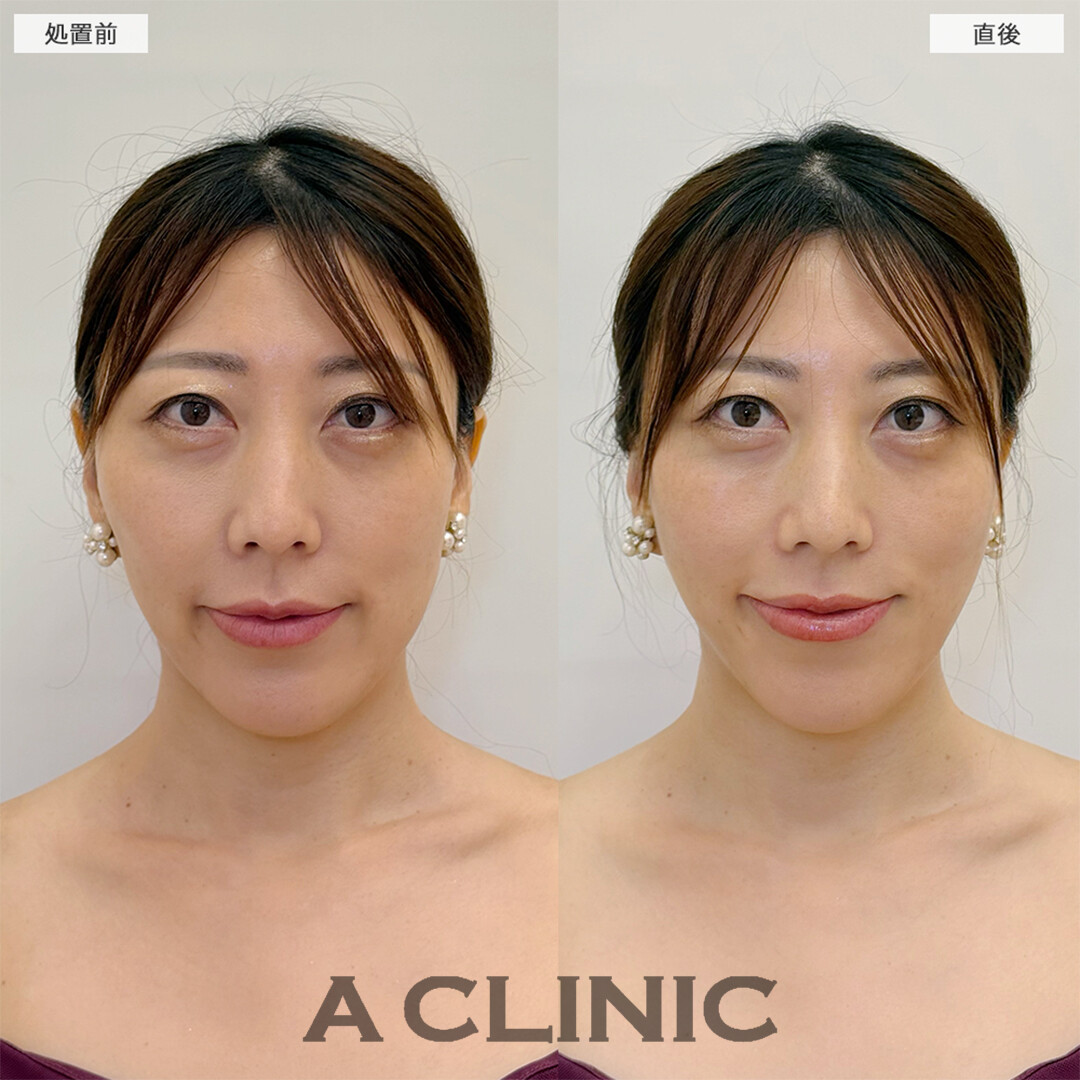 Aスレッドで自然な若返り大成功！こちら処置前と直後の症例です(40代女性)