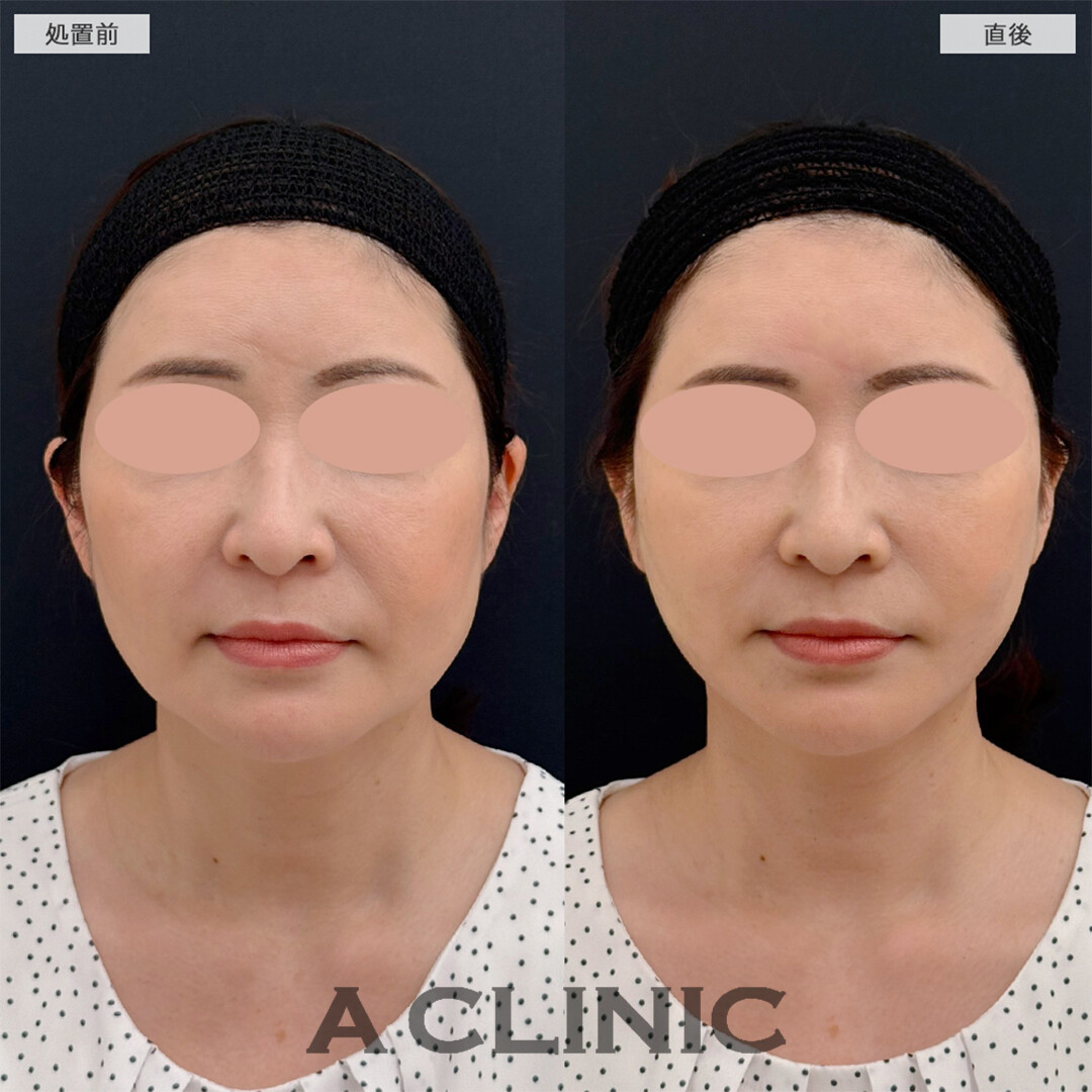 Aスレッドで左右差もなくなり若返り成功！こちら処置前と直後の症例です(50代女性)