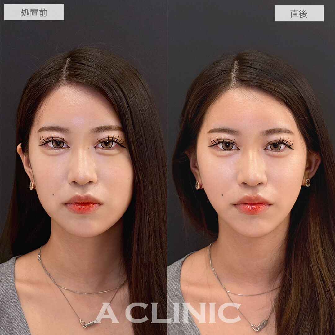 Aスレッドでフェイスラインのもたつきがしっかり上がりVフェイスに近づきました！こちら処置前と直後の症例です(20代女性)