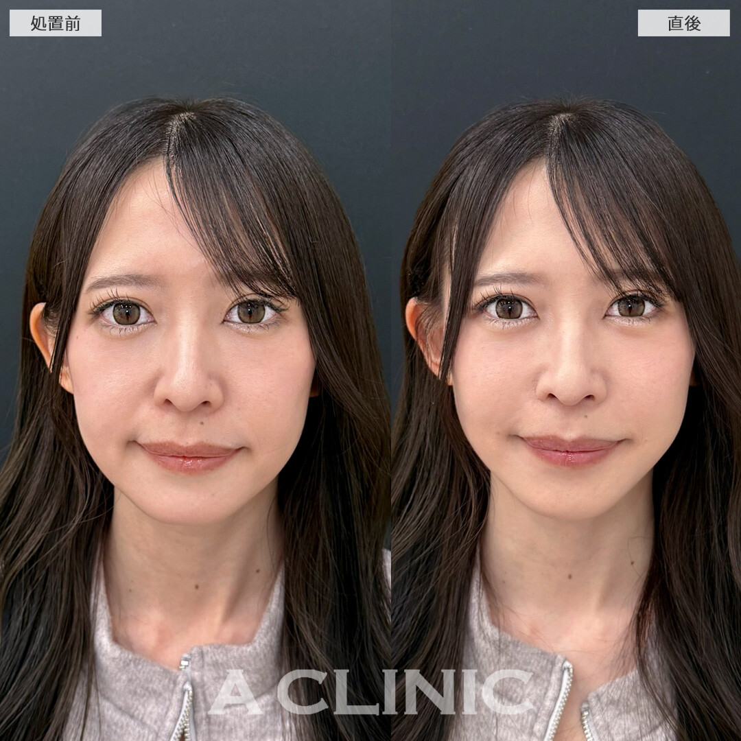 たるみやほうれい線の改善だけでなく中顔面短縮効果もございます！Aスレッドの処置前と直後の症例です(30代女性)