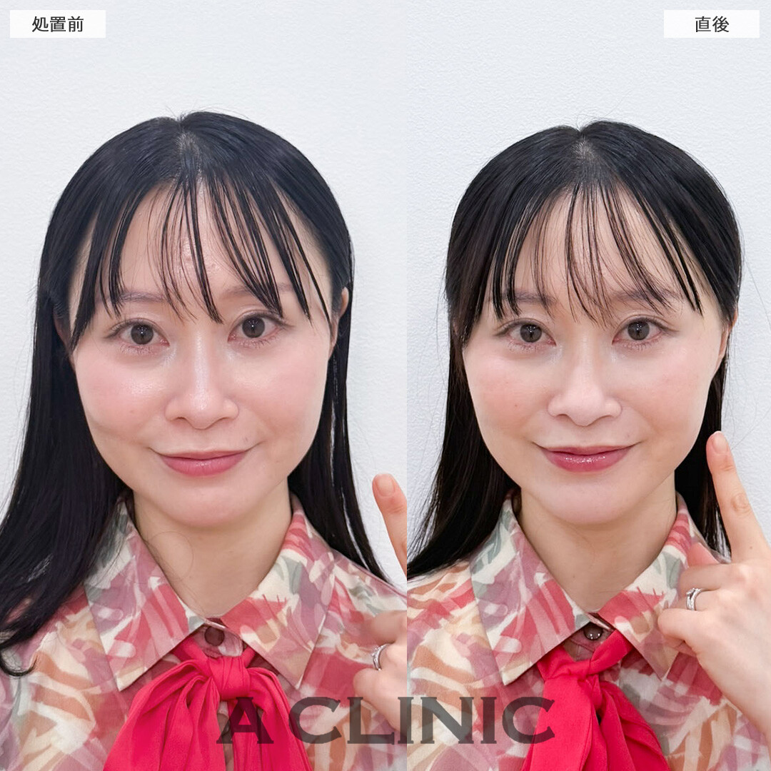 Aスレッドでたるみ引き上げてさりげなく若返り！こちら処置前と直後の症例です(30代女性)