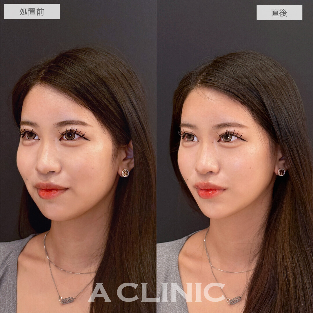 Aスレッドでフェイスラインのもたつきがしっかり上がりVフェイスに近づきました！こちら処置前と直後の症例です(20代女性)