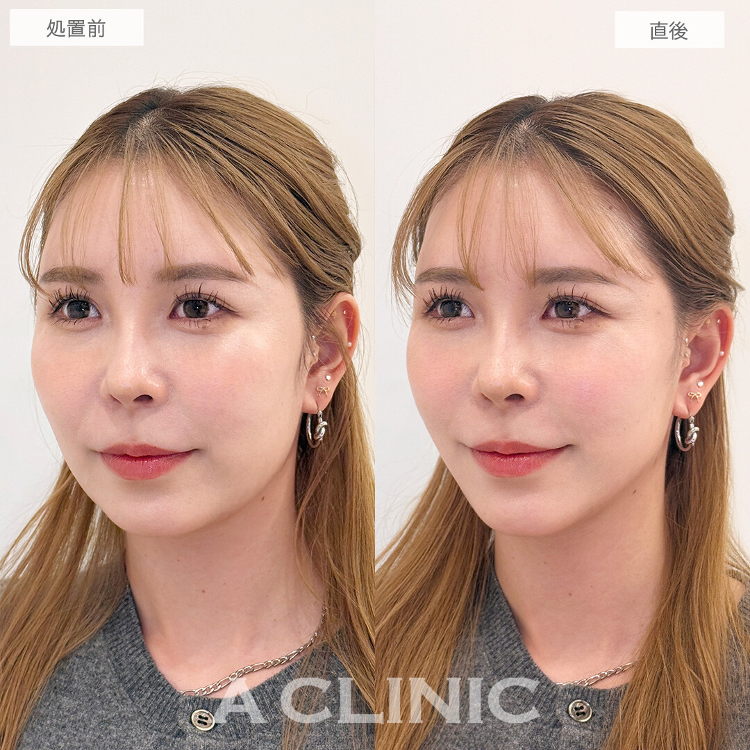 Aスレッドでリフトアップしてほうれい線も薄くなりました！こちら処置前と直後の症例です(30代女性)