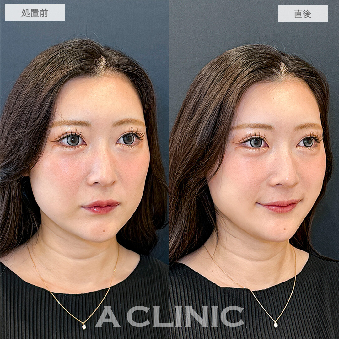 Aスレッドで頬コケと口横のもたつきが改善して輪郭が整いました！こちら処置前と直後の症例です(30代女性)
