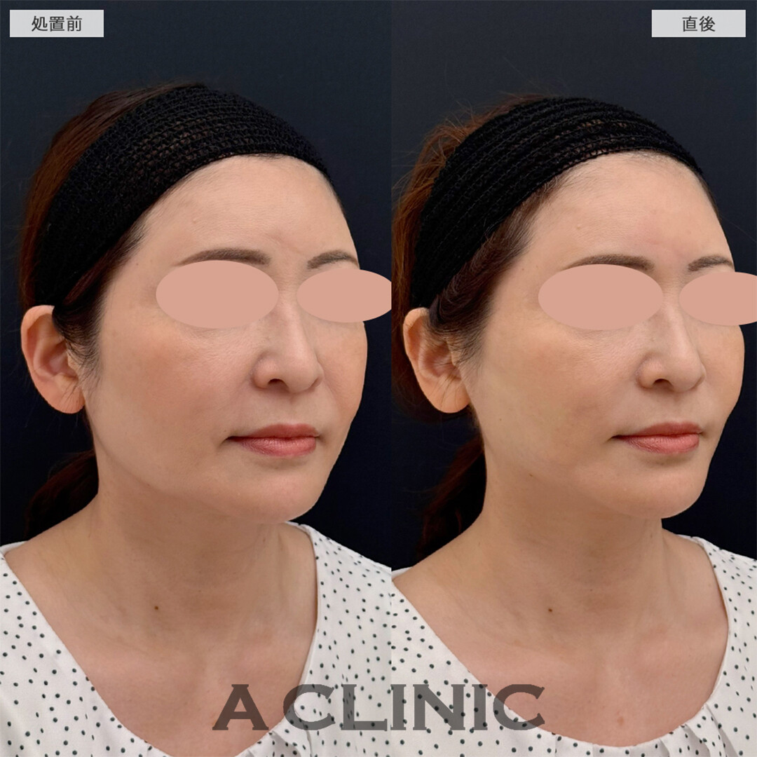 Aスレッドで左右差もなくなり若返り成功！こちら処置前と直後の症例です(50代女性)