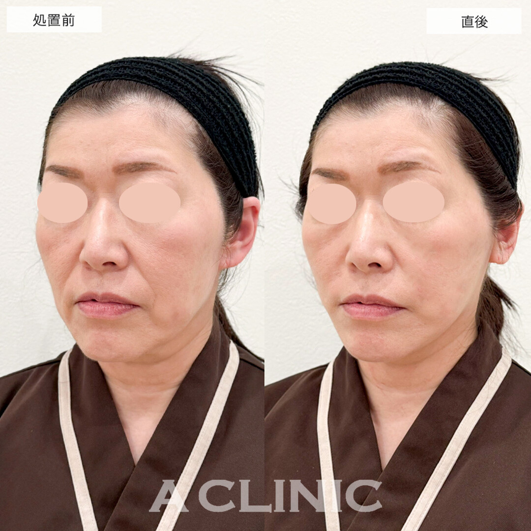 Aスレッドでたるみを引き上げ約15分で理想の輪郭に!こちら処置前と直後の症例です(50代女性)