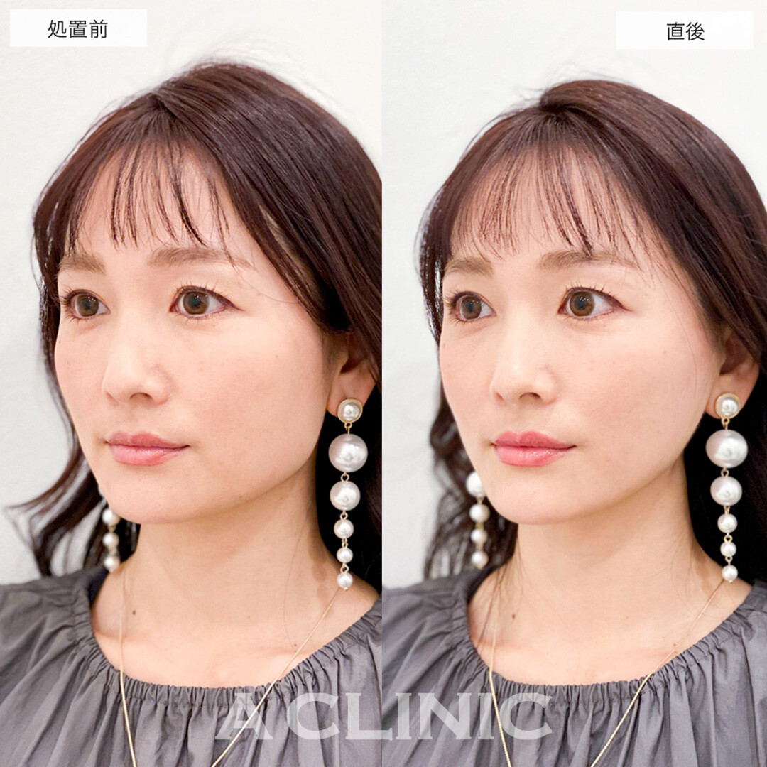 Aスレッドで輪郭の左右差が改善し自信が持てるようになりました!こちら処置前と直後の症例です(30代女性)