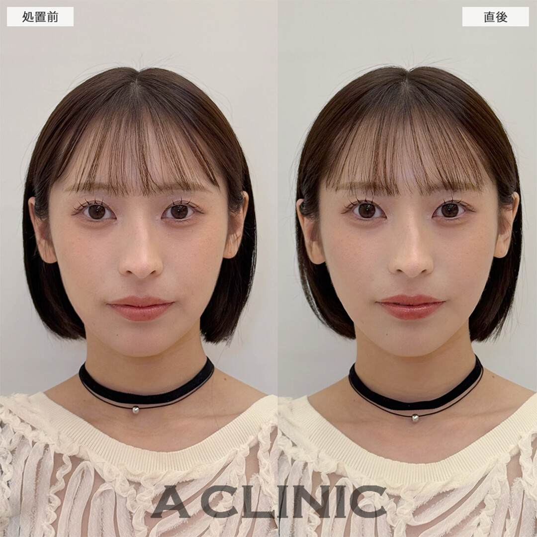 Aスレッドは周りにバレずにナチュラルな卵型輪郭になります！こちら処置前と直後の症例です(20代女性)