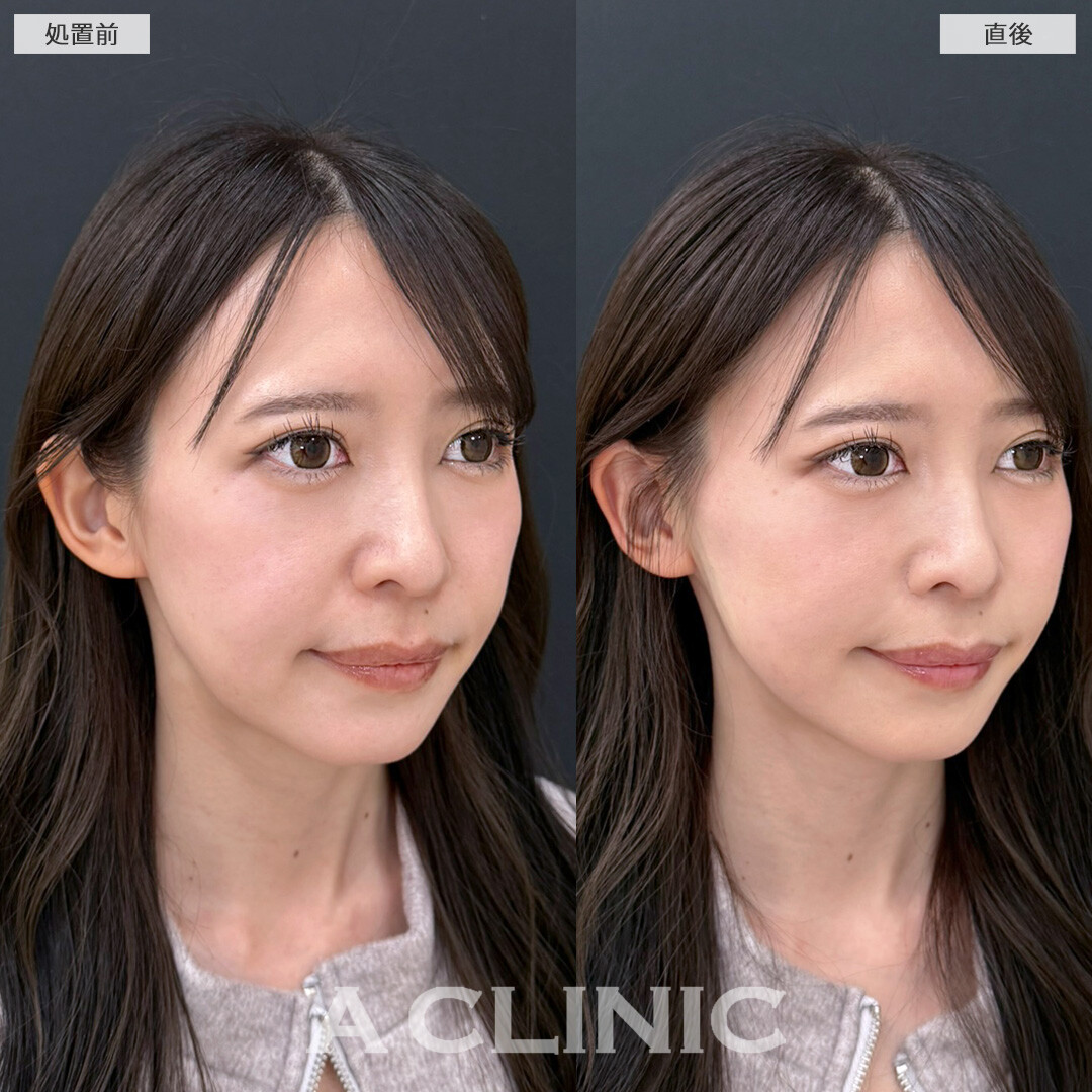 たるみやほうれい線の改善だけでなく中顔面短縮効果もございます！Aスレッドの処置前と直後の症例です(30代女性)