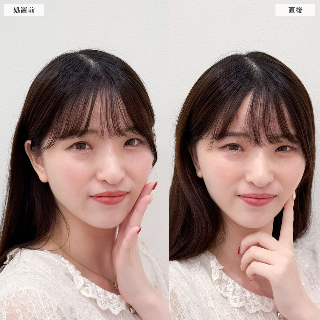 Aスレッドできれいなフェイスラインが爆誕！こちら処置前と直後の症例です(20代女性)