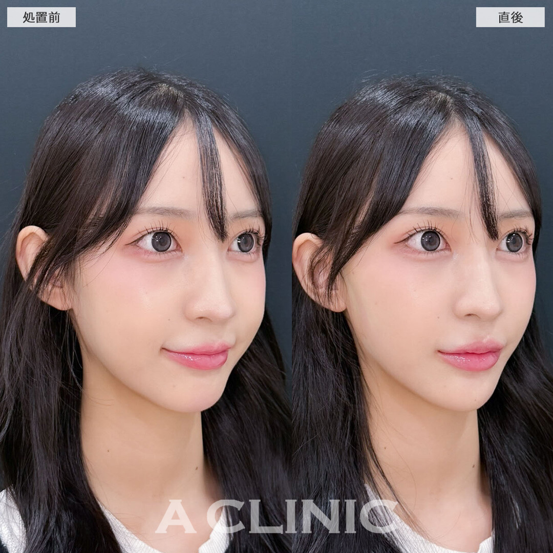Aスレッドとあごへのヒアルロン酸注入で洗練された印象のVフェイスに！こちら処置前と直後の症例です(10代女性)