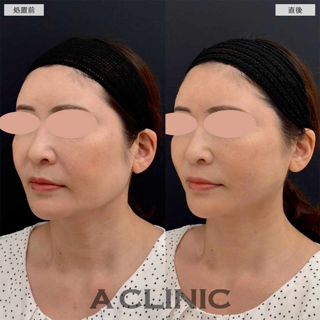 Aスレッドで左右差もなくなり若返り成功！こちら処置前と直後の症例です(50代女性)