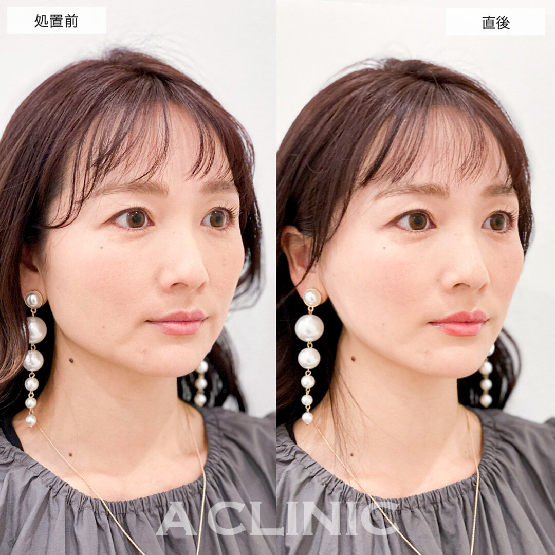 Aスレッドで輪郭の左右差が改善し自信が持てるようになりました!こちら処置前と直後の症例です(30代女性)