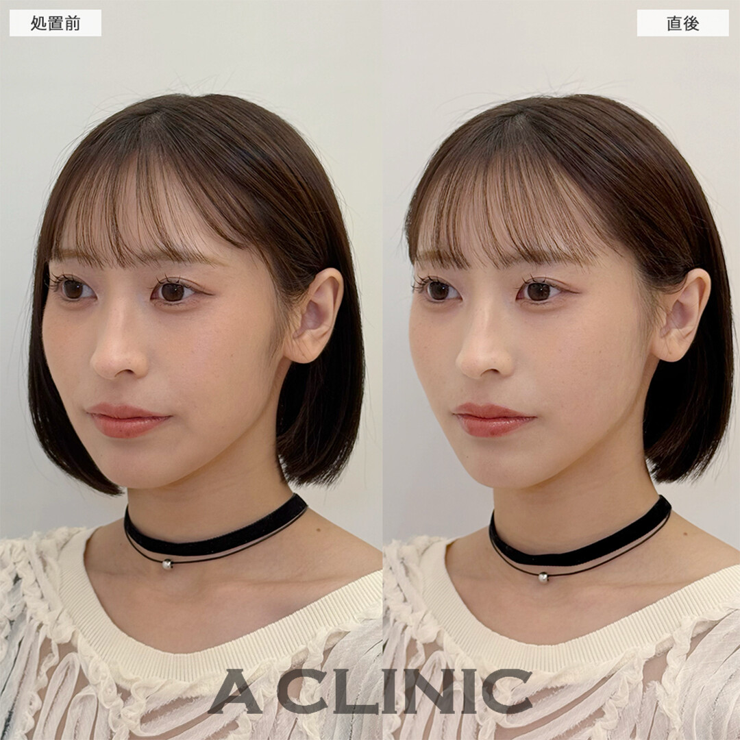 Aスレッドは周りにバレずにナチュラルな卵型輪郭になります！こちら処置前と直後の症例です(20代女性)