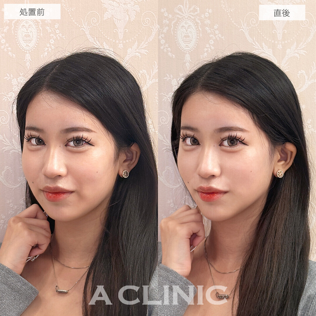 Aスレッドでフェイスラインのもたつきがしっかり上がりVフェイスに近づきました！こちら処置前と直後の症例です(20代女性)
