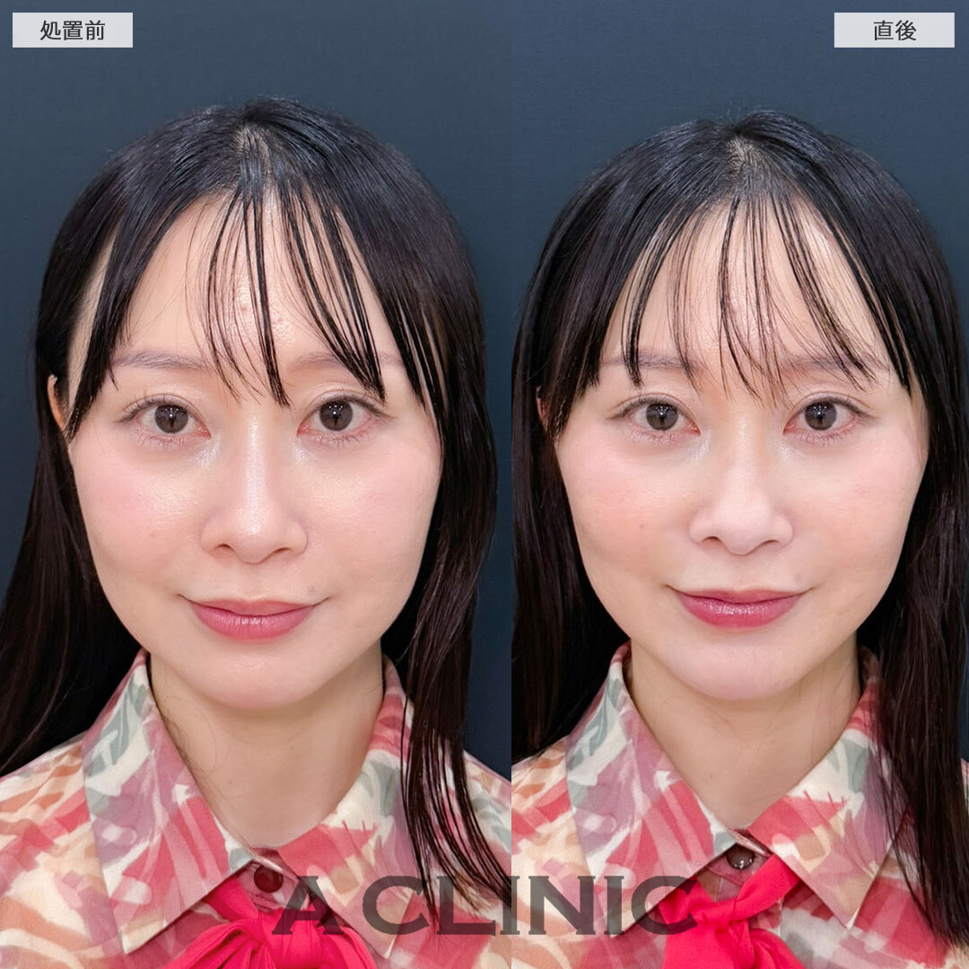 Aスレッドでたるみ引き上げてさりげなく若返り！こちら処置前と直後の症例です(30代女性)