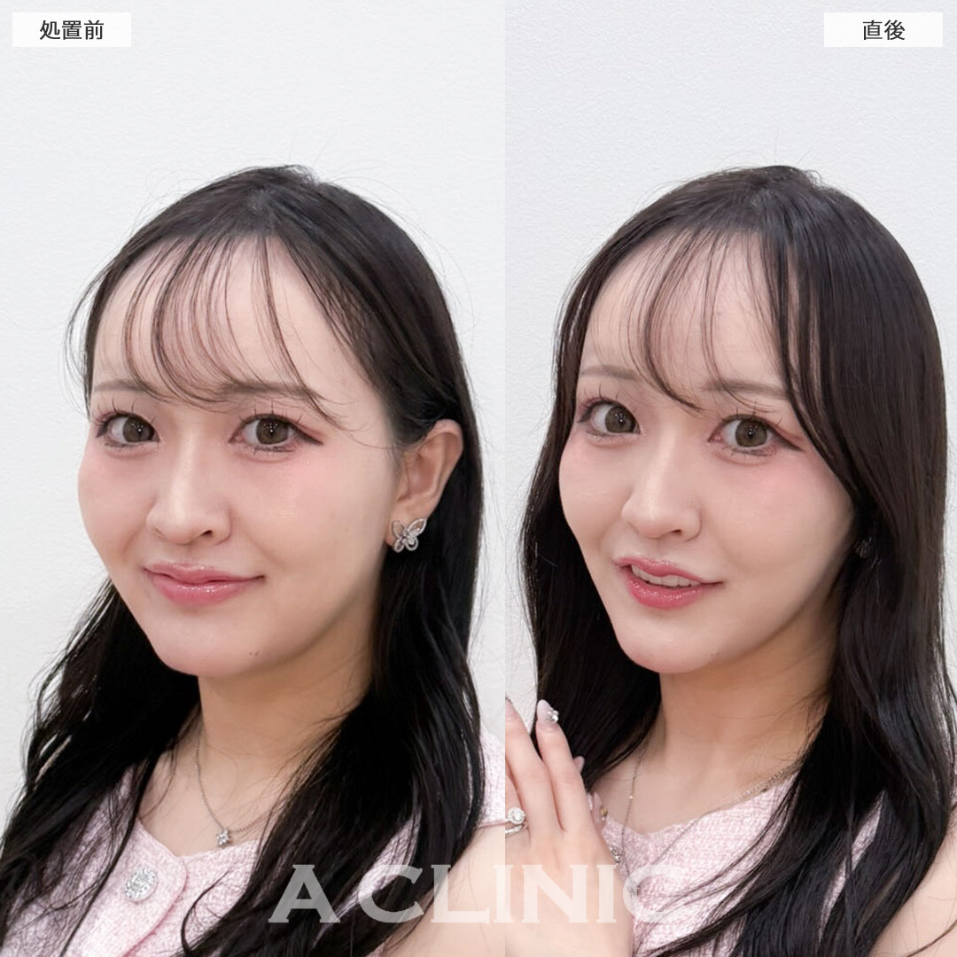 Aスレッドとあごへのヒアルロン酸注入でたるみをがっつり引き上げてたまご型フェイスに！こちら処置前と直後の症例です(20代女性)