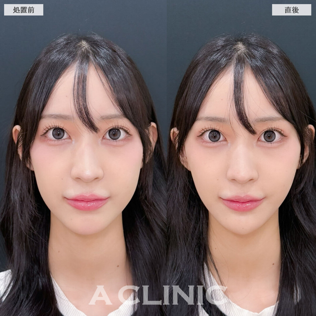 Aスレッドとあごへのヒアルロン酸注入で洗練された印象のVフェイスに！こちら処置前と直後の症例です(10代女性)