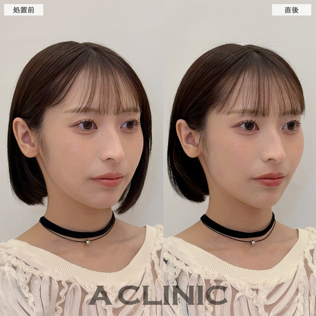 Aスレッドは周りにバレずにナチュラルな卵型輪郭になります！こちら処置前と直後の症例です(20代女性)