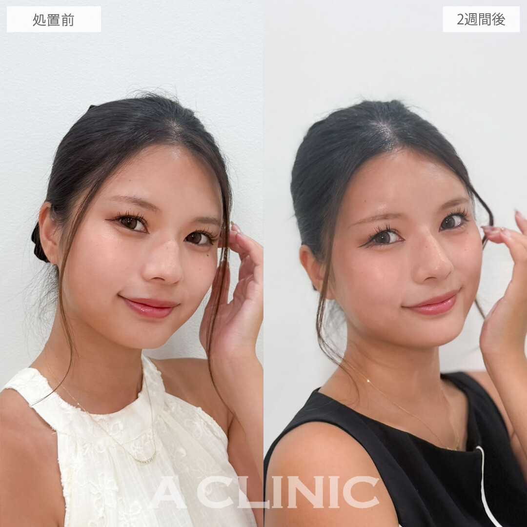 ヒアルロン酸カスタマイズメニューで顔を立体的に美しく！こちら処置前と2週間後の症例です(20代女性)