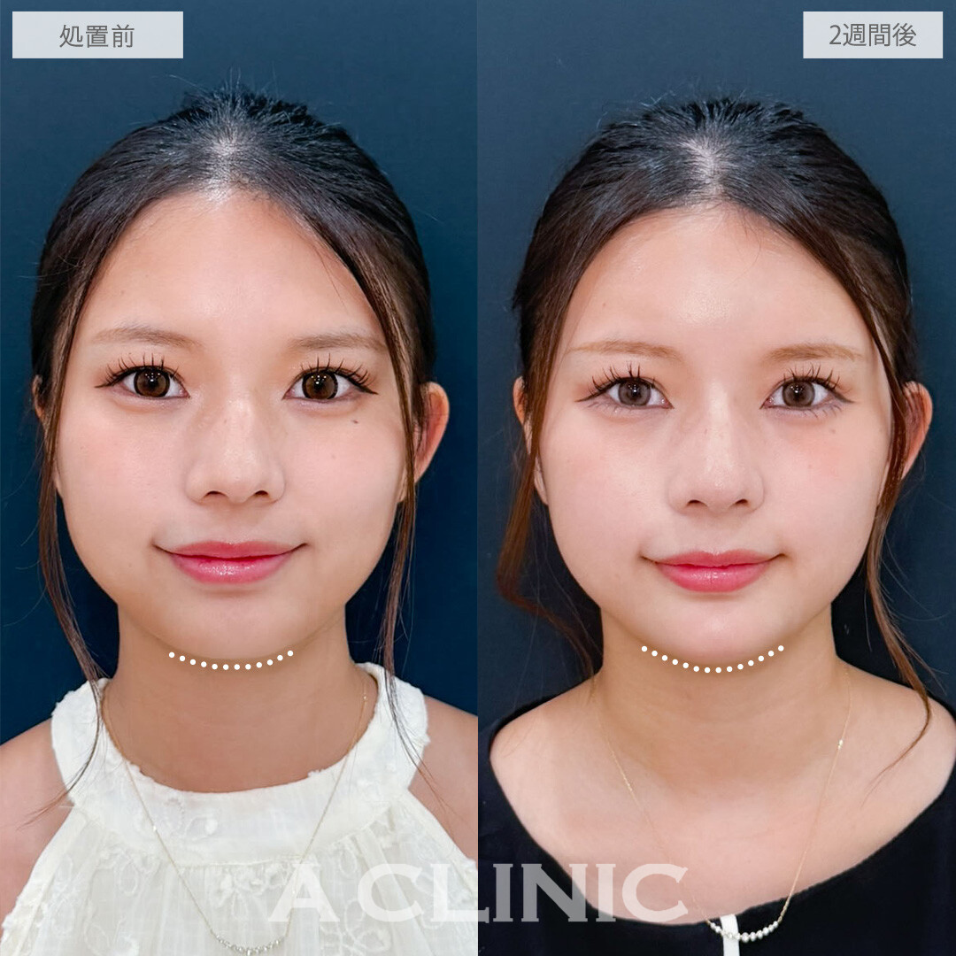 ヒアルロン酸カスタマイズメニューで顔を立体的に美しく！こちら処置前と2週間後の症例です(20代女性)