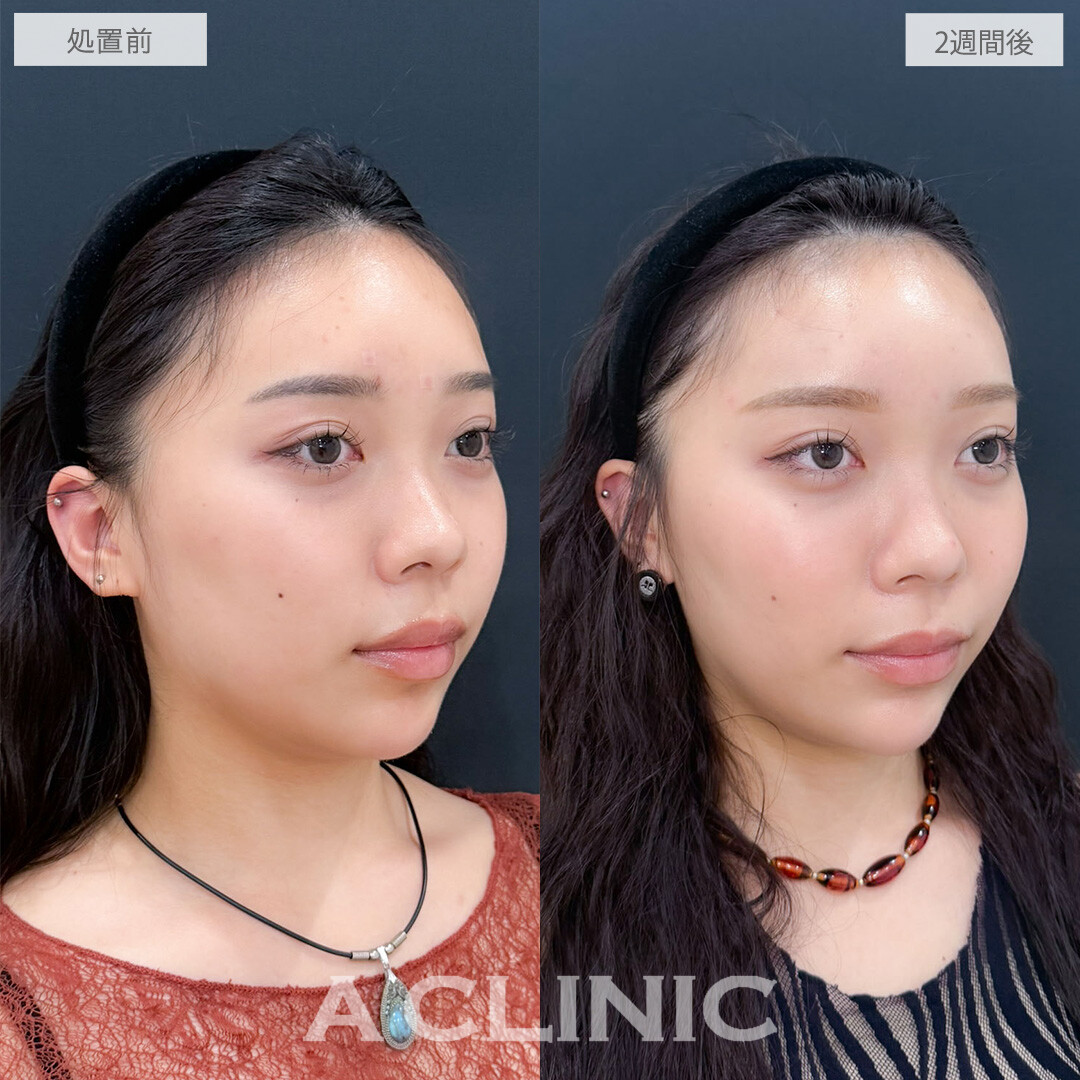 ヒアルロン酸カスタマイズメニューは気になる凹みを一気に改善できます！こちら処置前と2週間後の症例です(20代女性)