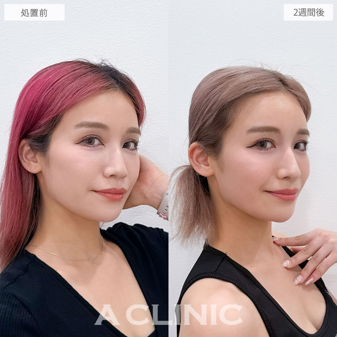 ヒアルロン酸カスタマイズメニューできれいな鼻筋を手に入れて全体的に凹みもなくせました！こちら処置前と2週間後の症例です(20代女性)