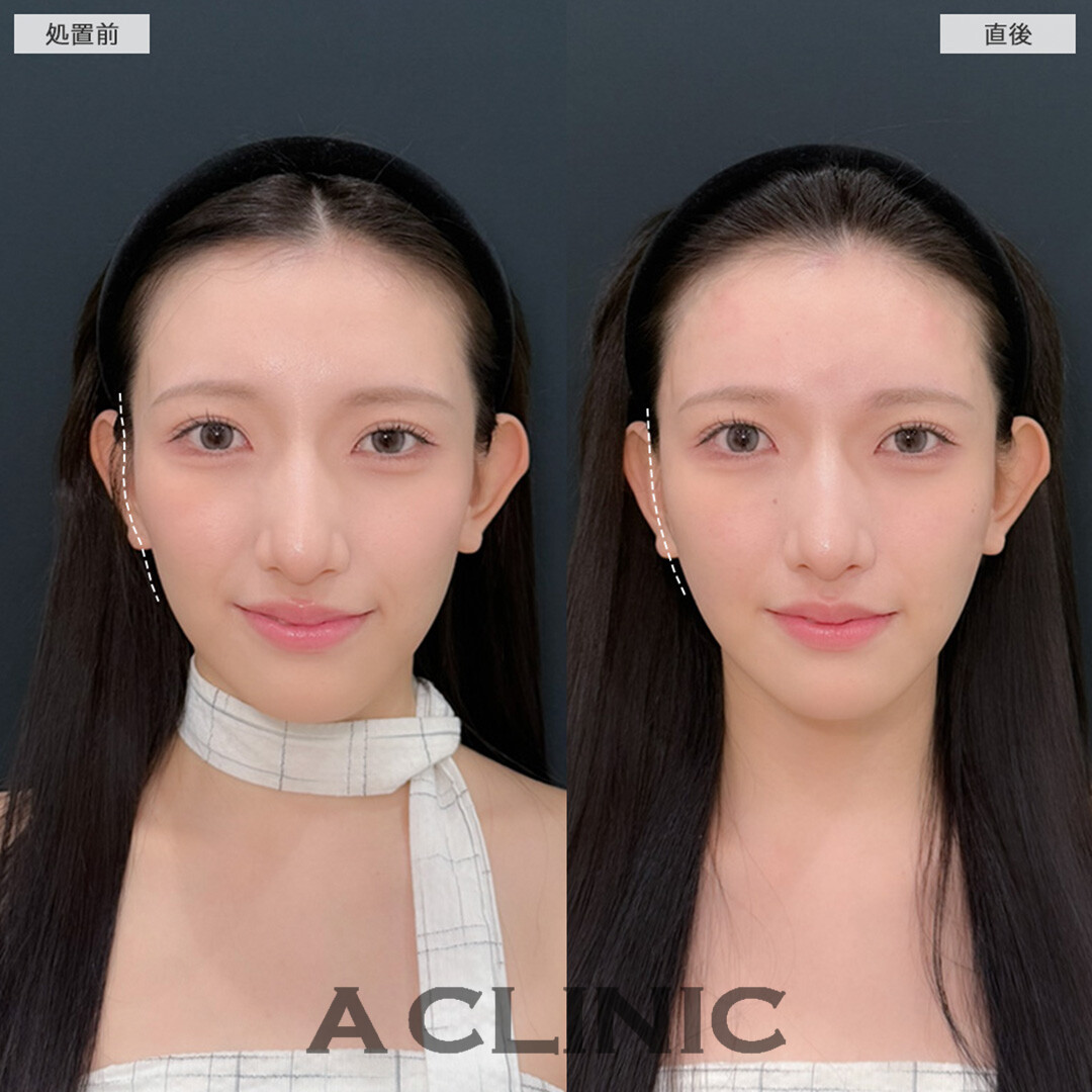 ヒアルロン酸カスタマイズメニューで気になる骨格の凹みや影線は整います!こちら処置前と直後の症例です(20代女性)