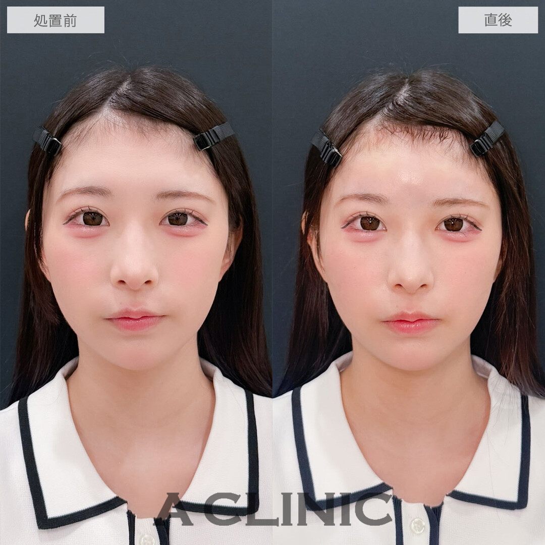 ヒアルロン酸カスタマイズメニューはお悩みを一気に解消できます！こちら処置前と直後の症例です(20代女性)