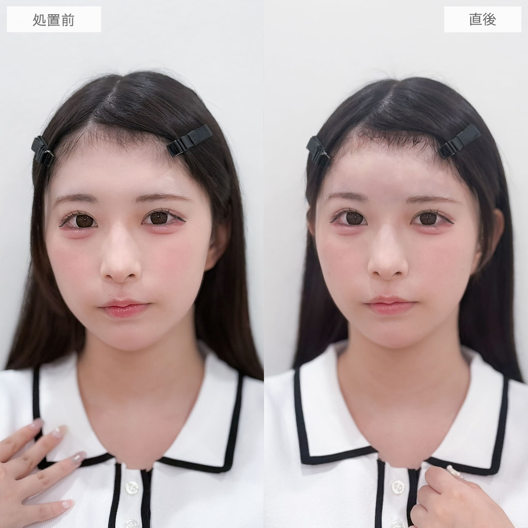 ヒアルロン酸カスタマイズメニューはお悩みを一気に解消できます！こちら処置前と直後の症例です(20代女性)