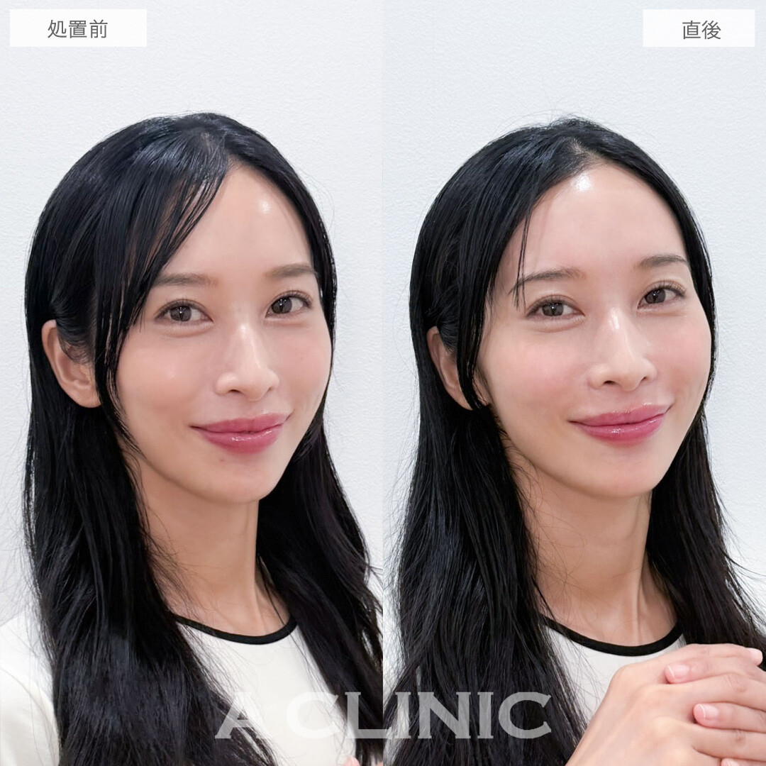 ヒアルロン酸カスタマイズメニューで気になっていた頬とおでこの凹みもほうれい線も一気に解消されました！こちら処置前と直後の症例です(30代女性)